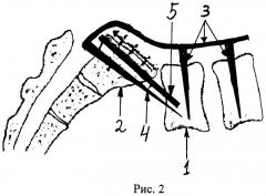 Способ хирургического лечения спондилоптоза пятого поясничного позвонка у детей (патент 2444300)