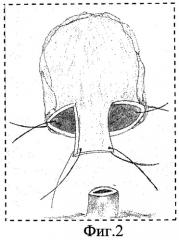Способ формирования шейки мочевого пузыря после простатэктомии (патент 2462201)