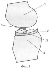 Способ консервативного лечения перелома переднего межмыщелкового возвышения большеберцовой кости (патент 2421189)