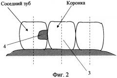 Коронка для дифференциальной диагностики этиологии аллергической реакции (патент 2326620)