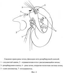 Способ одномоментного закрытия раны и полостной системы почки при лапароскопической резекции (патент 2532942)