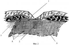 Способ пластики при грыжах передней брюшной стенки (патент 2407456)