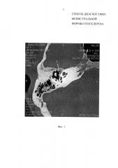 Способ диагностики фенестральной формы отосклероза (патент 2647333)