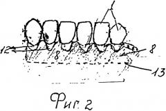 Способ вестибулопластики полости рта (патент 2531446)