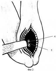 Способ лечения отрыва дистального сухожилия двуглавой мышцы плеча (патент 2284782)