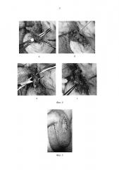 Способ малоинвазивной микрохирургической варикоцелэктомии мошоночным доступом (патент 2663074)