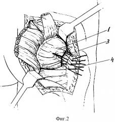 Способ профилактики вывихов головки эндопротеза тазобедренного сустава (патент 2293533)