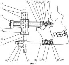 Дистрактор височно-нижнечелюстного сустава (патент 2313302)