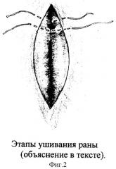 Способ ушивания раны при радикальной операции по поводу эпителиального копчикового хода (патент 2305499)