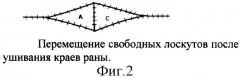 Способ сочетанного закрытия дефекта кожи местными тканями и свободными кожными лоскутами (патент 2326609)