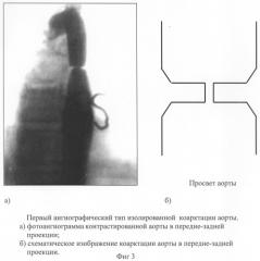 Способ диагностики изолированной коарктации аорты и способ выбора тактики ее лечения (патент 2244510)