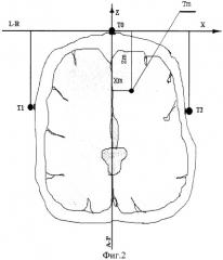 Способ наведения стереотаксического инструмента на целевую точку головного мозга (патент 2257178)