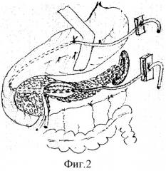 Способ лечения хронических ложных кист головки поджелудочной железы, сообщающихся с главным панкреатическим протоком (патент 2277870)