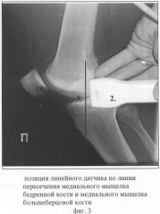 Способ комплексной ультразвуковой диагностики повреждения внутреннего мениска коленного сустава в области тела и переднего рога (патент 2305493)