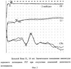 Способ оценки тяжести инфекционного поражения цнс у детей (патент 2295281)