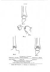 Способ пластического восстановления суставных поверхностей (патент 1113101)