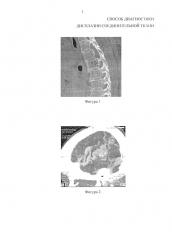 Способ диагностики дисплазии соединительной ткани (патент 2665387)