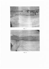 Способ комплексного лечения пограничных ожогов кожи (патент 2618914)
