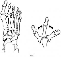 Способ оперативного лечения деформации переднего отдела стопы (патент 2428127)