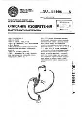 Способ резекции желудка (патент 1144691)