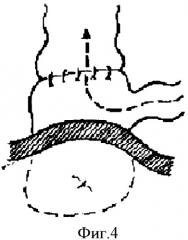Способ цекостомии при хирургическом лечении болезни гиршпрунга (патент 2341204)