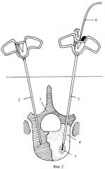 Способ малоинвазивного хирургического лечения опухолей позвонков (патент 2353315)
