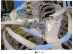 Способ фиксации ключично-стернального сочленения при вывихе ключицы (патент 2402299)