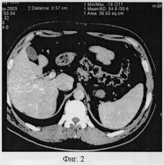 Способ компьютерно-томографической диагностики аномалий развития печени (патент 2297793)