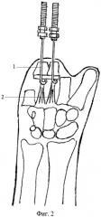 Способ реконструкции пястных костей (патент 2489980)