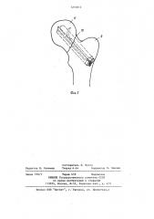 Устройство для остеосинтеза шейки бедренной кости (патент 1210812)