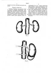 Способ устранения двустороннего стеноза почечных артерий (патент 1364317)