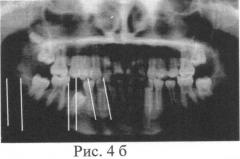 Способ коррекции направления прорезывания постоянных боковых зубов (патент 2546098)