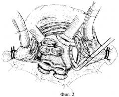 Способ модифицированной фрагментации предсердий при коррекции приобретенных пороков сердца, осложненных фибрилляцией предсердий (патент 2476166)