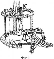Способ остеосинтеза аппаратом орто-сув при деформациях среднего отдела стопы (патент 2489106)