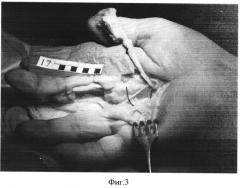 Способ восстановления утраченного первого пальца кисти (патент 2550935)