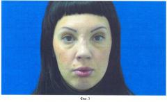 Способ хирургического лечения седловидной деформации спинки носа (патент 2420242)