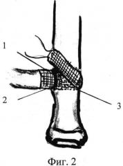Способ пластики оторванного сухожилия двуглавой мышцы (патент 2552692)