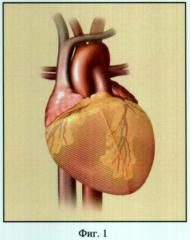 Устройство для хирургического лечения ишемической и дилатационной кардиомиопатии (патент 2312611)