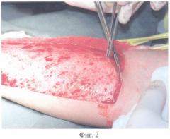 Способ подготовки кожно-фасциального лоскута (патент 2316268)