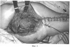 Способ пластики островковым мышечным лоскутом после радикальной хирургической обработки остеомиелитического очага в области вертлужной впадины (патент 2299031)