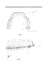 Способ дистализации боковой группы зубов верхней челюсти (патент 2610020)