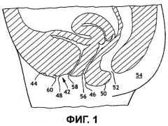 Интерлабиальная прокладка (патент 2286757)