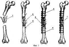 Способ лечения оскольчатых переломов (патент 2243738)