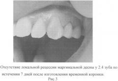 Способ восстановления дефектов зубов (патент 2460490)