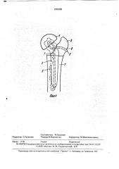 Эндопротез (патент 1800980)