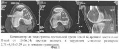 Способ лечения пострезекционных полостей трубчатых костей (патент 2322207)