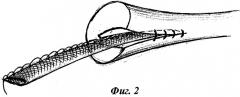 Способ протезирования сухожилий (патент 2340303)