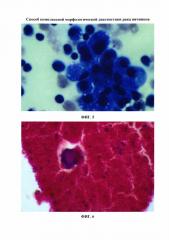 Способ комплексной морфологической диагностики рака яичников (патент 2640189)
