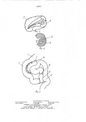 Способ лечения свища поджелудочной железы (патент 1066571)