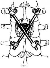 Способ транспедикулярной фиксации поврежденного позвоночного сегмента (патент 2271765)